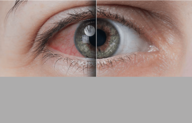 Enfermedad del ojo seco causada por infecciones virales