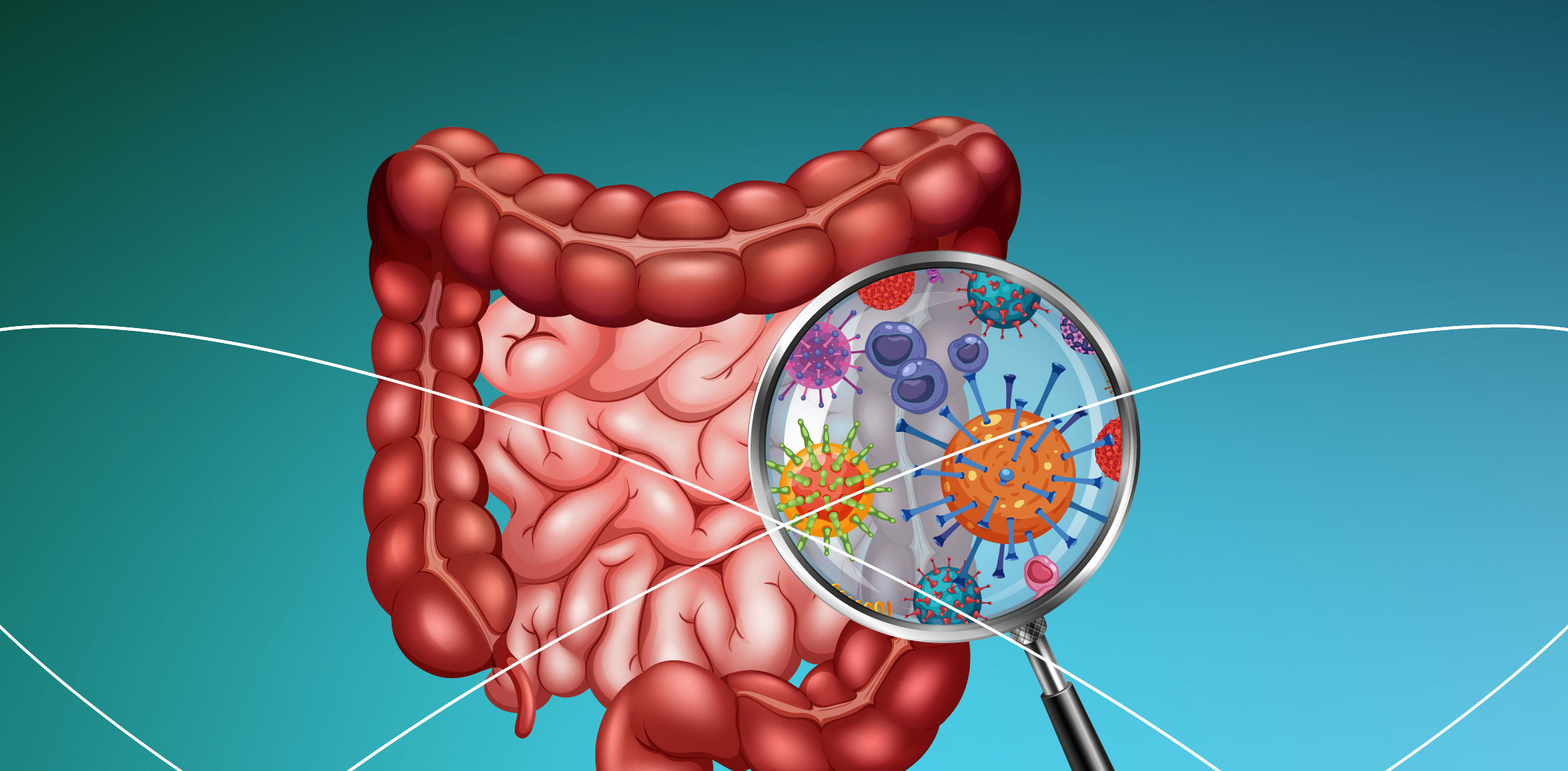 Microbiota como factor de riesgo en la aparición de glaucoma