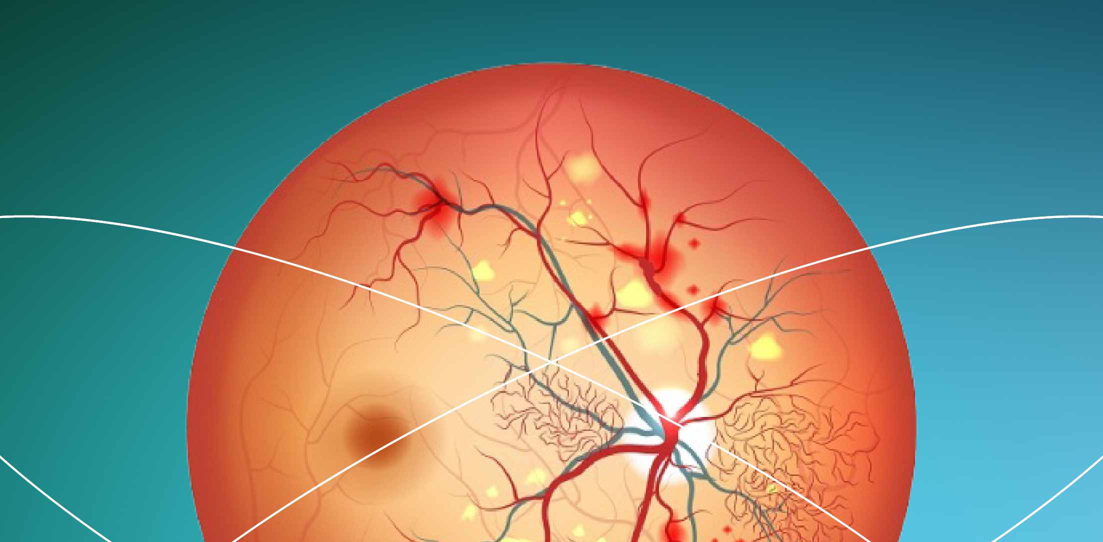 Retinopatía diabética en cifras